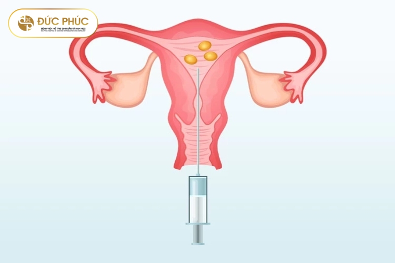 Thủ thuật chọc hút trứng 