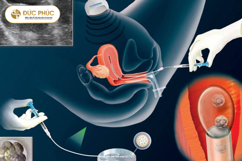 Phôi được chuyển vào cơ thể mẹ