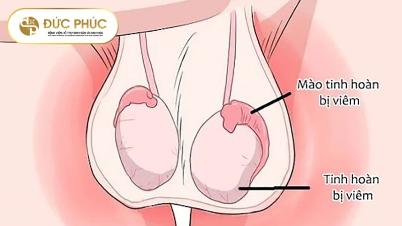 Viêm tinh hoàn ở nam giới