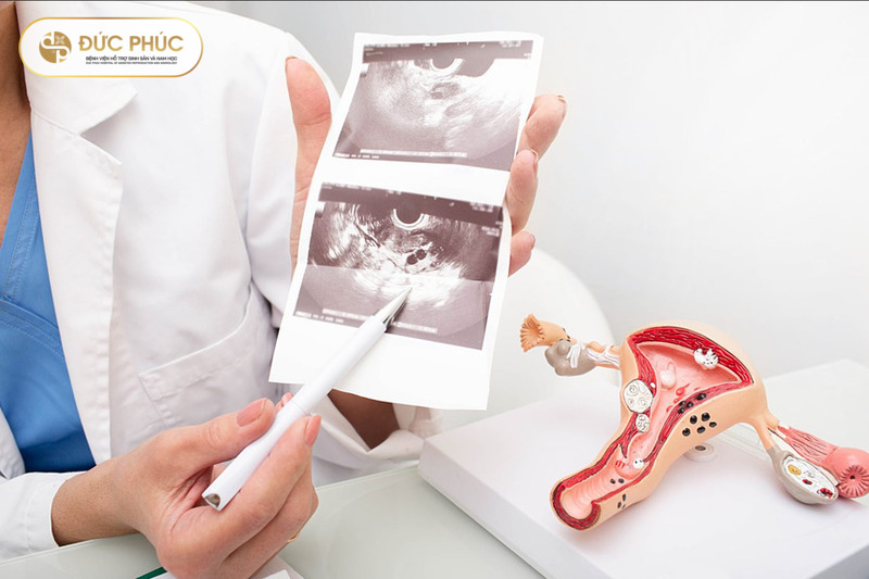 Sau bao lâu có thể làm IVF lần 2